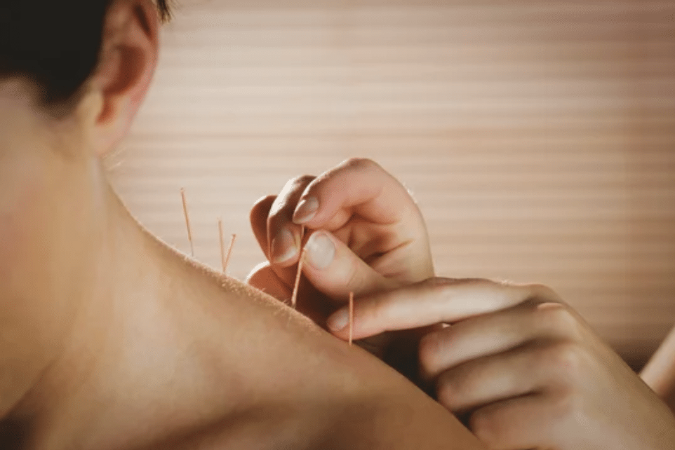 Using Acupuncture to relief rotator cuff injury.